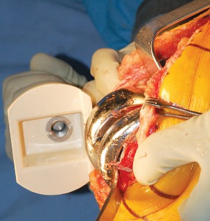 Illustration 34 for Mastering Gap Balancing in Revision TKA: Avoid Common Pitfalls