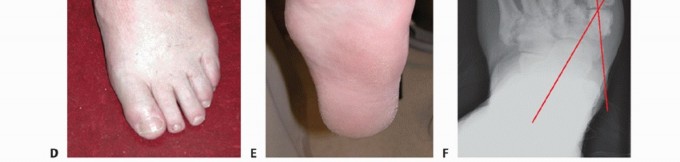 Illustration 8 for Regain Mobility: Surgical Solutions for Charcot Foot Arthropathy