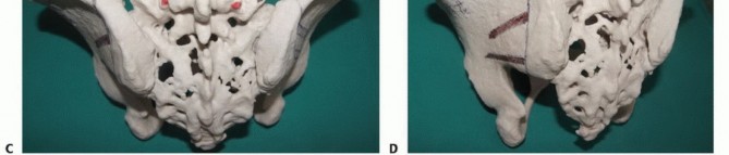 Illustration 51 for Sacral Tumor Surgery: Safeguarding Bowel & Bladder Control