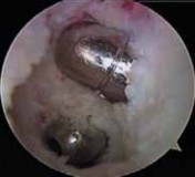 Illustration 17 for Cruciate Ligament Repair: Definitive Guide to Treatment & Recovery
