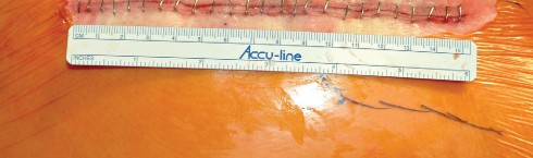 Illustration 71 for Direct Lateral Hip: Optimize Exposure with Sharp Curved Hohmann