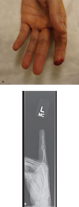 Is Your Hand Affected by Lumbrical Plus Deformity? Find Answers