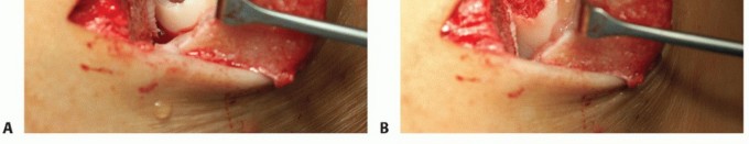 Illustration 9 for Restore Damaged Cartilage with Autologous Chondrocyte Transplantation