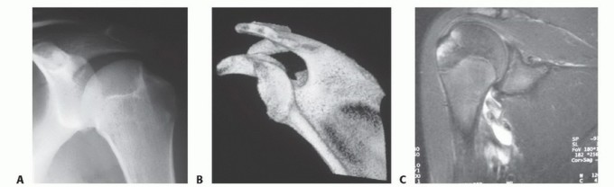 Illustration 5 for Regain Stability: Arthroscopy for Anterior Instability & the Inferior Glenohumeral Ligament