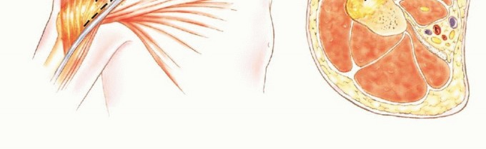 Illustration 11 for Limb-Sparing Resections Around the Shoulder: Optimizing Outcomes