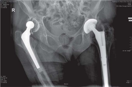 Illustration 71 for Optimizing Infected THA: The One Staged Approach Explained
