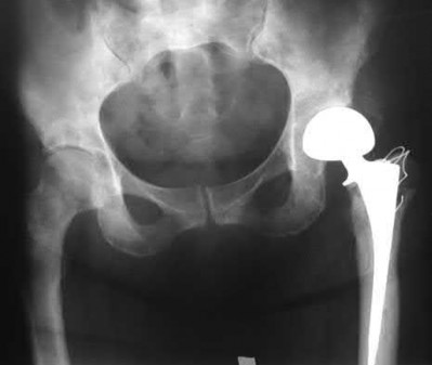 Illustration 66 for OrthoCash: Trauma MCQs & Cases for a yearold woman