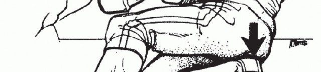 Illustration 7 for Restore Your Foot: Surgical Treatment for Hallux MP Joint Turf Toe