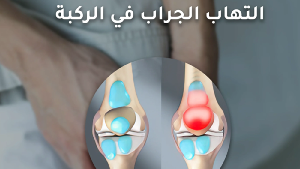 التهاب الجراب أو الالتهاب الكيسي في الركبة knee bursitis
