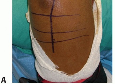 Illustration 32 for Radial Head & Neck Fractures: Mastering ORIF for Best Results