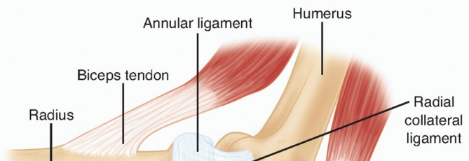 Radial Head Arthroplasty: Restoring Elbow Function & Stability