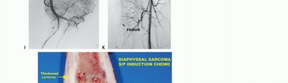 Illustration 23 for Understanding Benign Bone Tumors: Your Complete Preoperative Guide