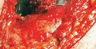 Illustration 67 for Unlock the Figure Posterior Approach to the Hip