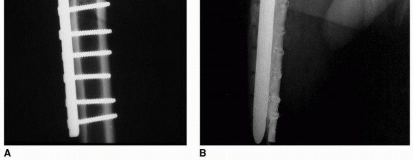 Illustration 11 for Sliding Trochanteric Osteotomy: Modern Role & Refined Techniques