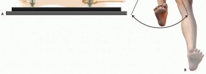 Illustration 15 for Retrograde Femoral Nailing: Optimizing Surgical Outcomes