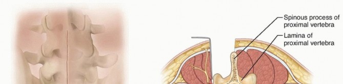 Illustration 11 for Mastering High-Grade Spondylolisthesis: Posterolateral and Interbody Fusion