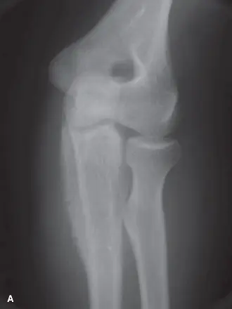 ساركوما إيوينج: دليل شامل من الأستاذ الدكتور محمد هطيف للتشخيص والعلاج والتعافي