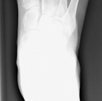 Illustration 2 for Bunionette Treatment: Is Lateral Condylar Resection Right for You?