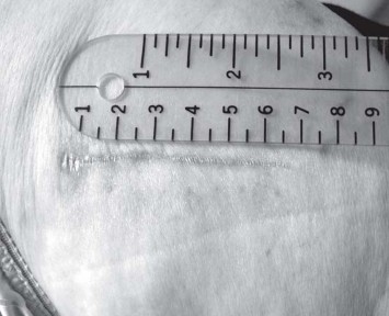 Illustration 64 for Exploring the Ambulatory Surgical Setting for Total Hip Replacement
