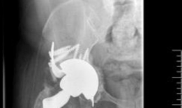 Illustration 7 for Solving Severe Acetabular Bone Loss with Cup-Cage Reconstruction