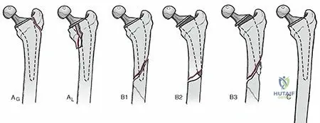 Illustration of type iv fractures - Dr. Mohammed Hutaif