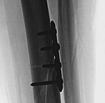 Illustration 12 for Complex Tibial Shaft Fracture: Plate Fixation for Plafond Extension