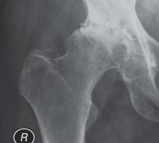 Illustration 43 for The Proxima: Why This Proximally Loading Implant Preserves Bone