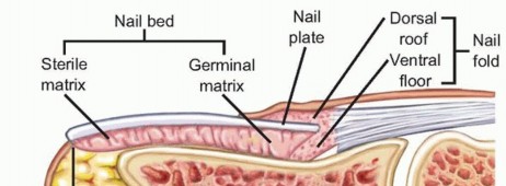 Illustration of distal phalanx fracture - Dr. Mohammed Hutaif