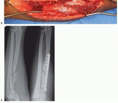 Illustration 26 for Optimal ORIF for Diaphyseal Forearm Fractures: Your Guide
