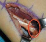 Illustration 6 for Unlocking Mobility: Distal Lengthening for Lateral Hamstring Muscle