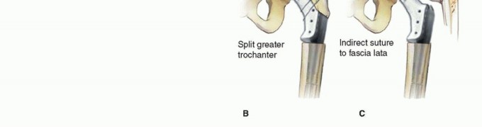 Illustration 14 for Limb Salvage: New Advances in Proximal Femoral Replacement