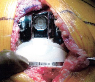 Illustration 21 for Minimally Invasive Subvastus: The Best Path to Quicker TKA Recovery