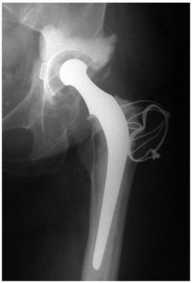 Sliding Trochanteric Osteotomy: Modern Role & Refined Techniques