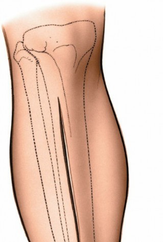 Illustration 59 for Surgical Access: Mastering the Tibia's Surface & Fibula Approaches