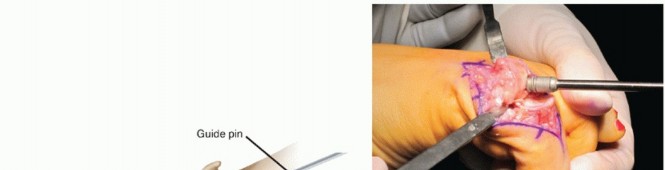 Illustration 22 for End Articular Cartilage Loss: Arthrosurface HemiCAP Resurfacing