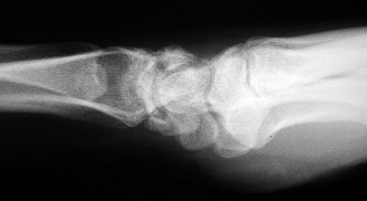 صورة طبية: دليل الأستاذ الدكتور محمد هطيف الشامل لأمراض وإصابات اليد والمعصم في صنعاء