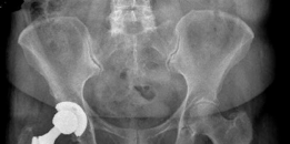 Illustration 5 for Achieving Success with Uncemented Hip Arthroplasty Metal Socket