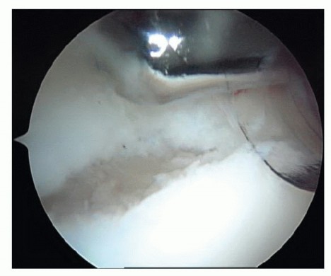 Heal Your Superior Labral Anterior Tear: Arthroscopic Treatment Guide