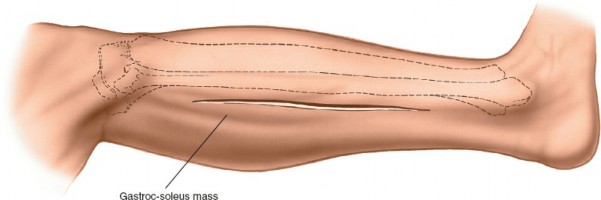 Illustration 72 for Surgical Access: Mastering the Tibia's Surface & Fibula Approaches