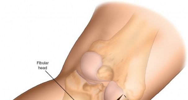Illustration 26 for Surgical Access: Mastering the Tibia's Surface & Fibula Approaches