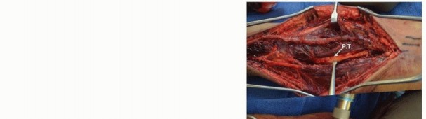 Illustration 9 for Optimal ORIF for Diaphyseal Forearm Fractures: Your Guide