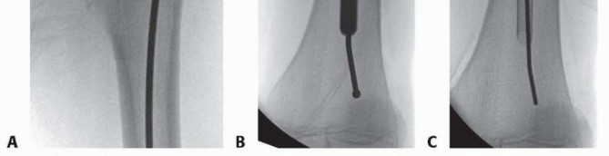 Illustration 20 for Pediatric Femoral Nailing: Targeting the Right aspect of the greater Trochanter