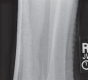 Illustration 28 for Optimal Fixation of the Ankle: Open Reduction & Internal Fixation