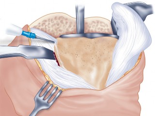 Illustration 34 for Precision Soft Tissue Balancing in Revision: Avoid TKA Pitfalls