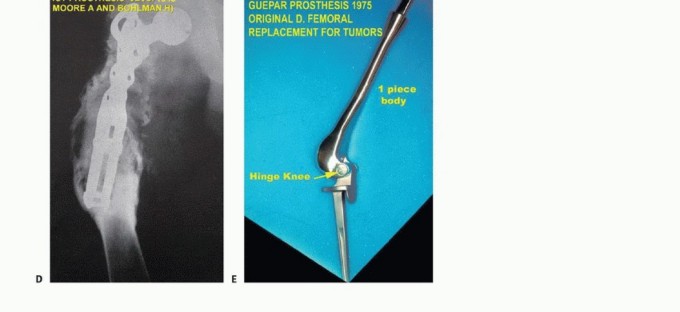 Illustration 3 for Distal Femoral Replacement: Key to Modern Limb Salvage