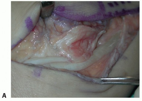 Illustration 38 for Beyond Primary Repair: Solutions for Peroneal Tendon Subluxation