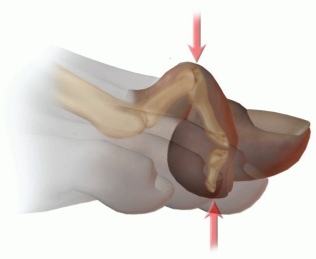 Illustration 2 for Hammer Toe Correction: Understanding the Extensor Digitorum Longus