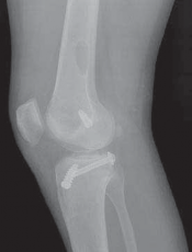 Illustration 27 for Cruciate Ligament Repair: Definitive Guide to Treatment & Recovery