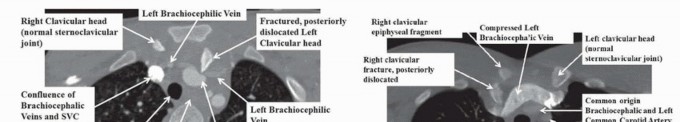 Sternoclavicular Fracture Injury: Prompt Diagnosis for Critical Cases