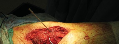 Illustration 67 for Figure Hip Resurfacing: Who Benefits and Who Should Avoid It?